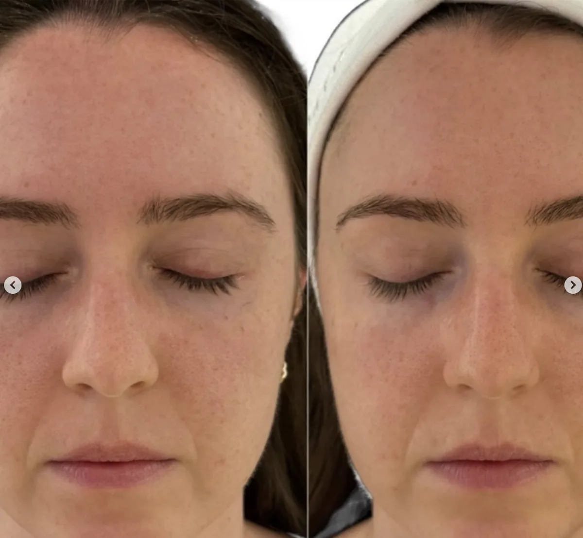 Client skin result 2, before and after treatment